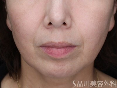 症例NO.70141のBEFORE写真