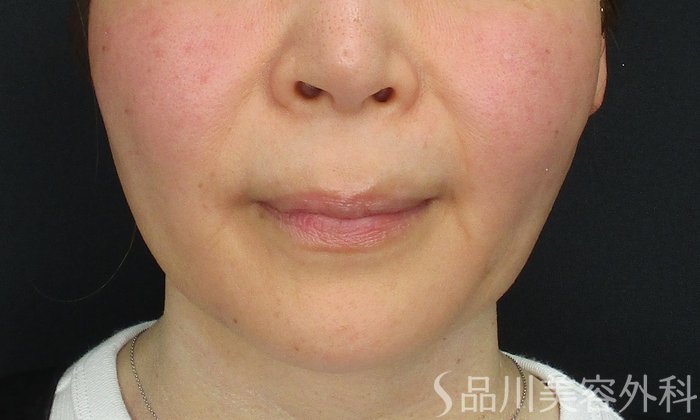 症例NO.71264のBEFORE写真