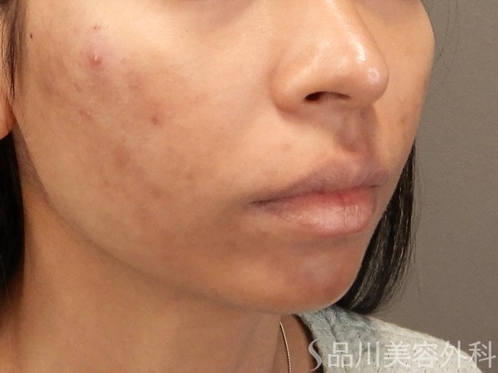 症例NO.70499のAFTER写真