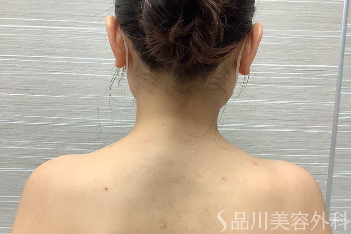 症例NO.62062のBEFORE写真