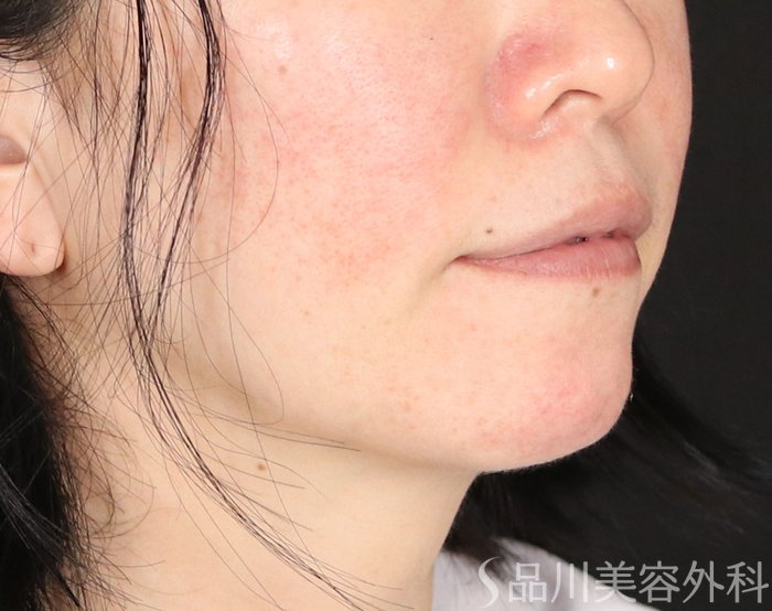 症例NO.73882のBEFORE写真