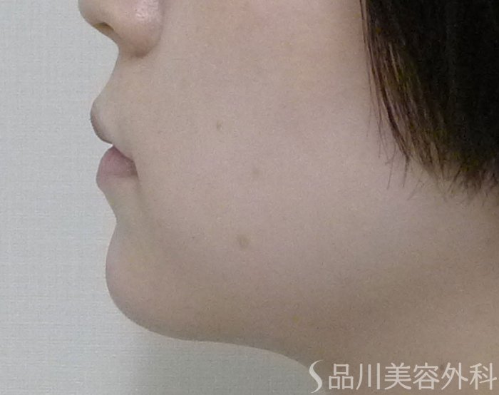 症例NO.73407のAFTER写真