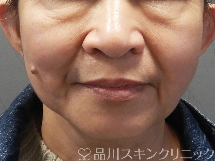 症例NO.72395のBEFORE写真