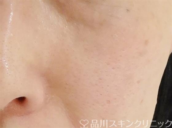 症例NO.35642のAFTER写真