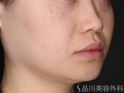 症例NO.70644のBEFORE写真
