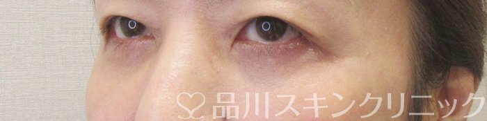 症例NO.70229のAFTER写真