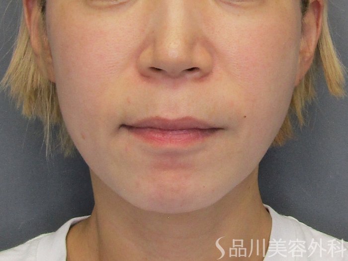 症例NO.75022のBEFORE写真