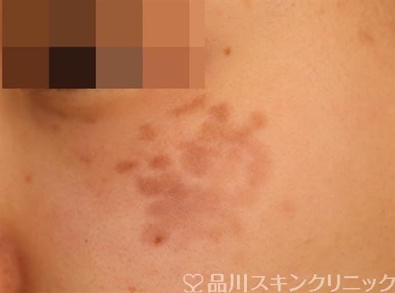 症例NO.54206のBEFORE写真