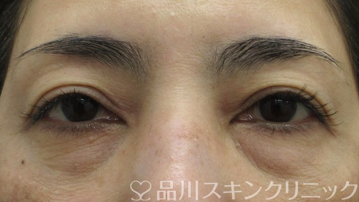 症例NO.74354のBEFORE写真