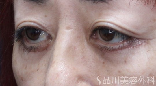 症例NO.71148のAFTER写真