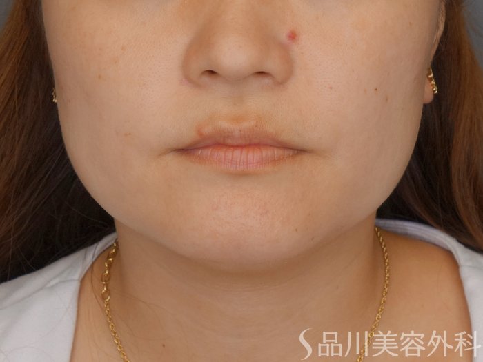 症例NO.71634のBEFORE写真