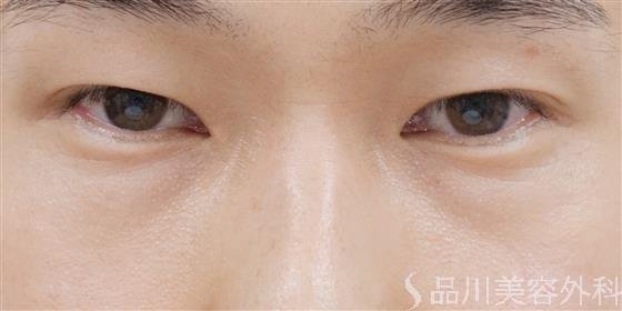 症例NO.39535のBEFORE写真