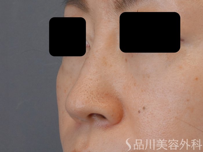 症例NO.72632のBEFORE写真