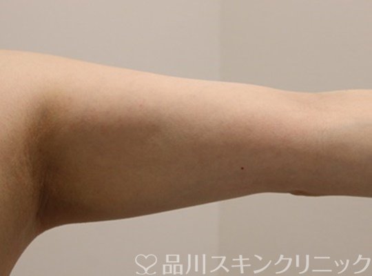 症例NO.72099のAFTER写真