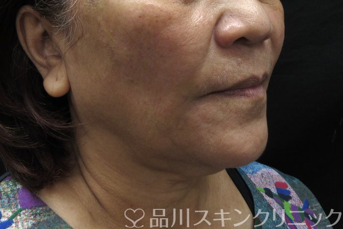 症例NO.74642のAFTER写真