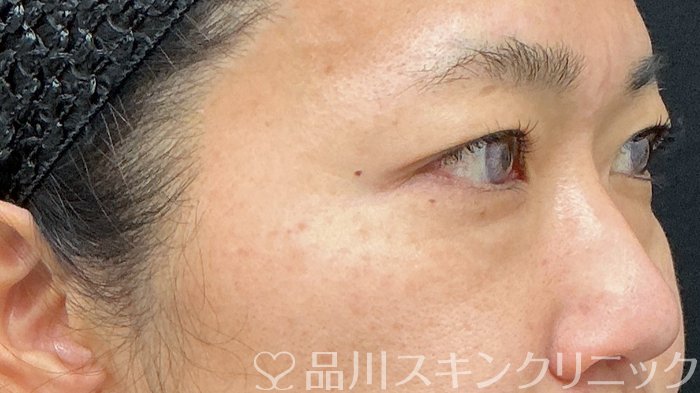 症例NO.73582のBEFORE写真