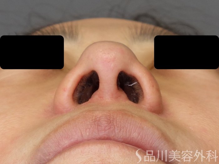 症例NO.65299のBEFORE写真