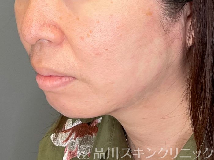 症例NO.69460のAFTER写真