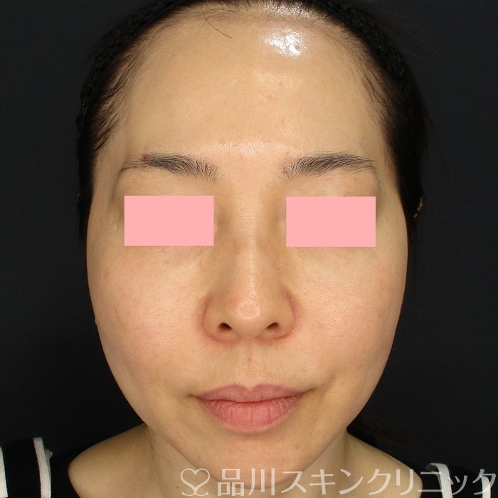 症例NO.73634のBEFORE写真