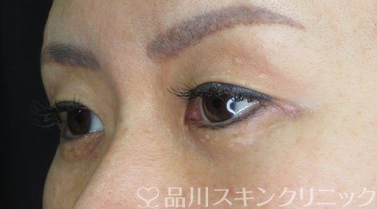 症例NO.69634のBEFORE写真