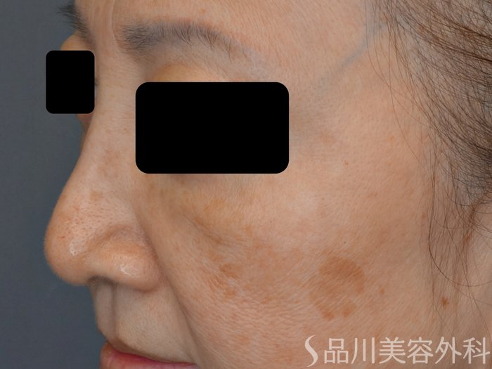 症例NO.73964のBEFORE写真