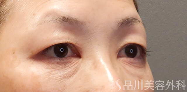 症例NO.74645のBEFORE写真