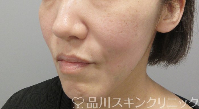 症例NO.69837のAFTER写真