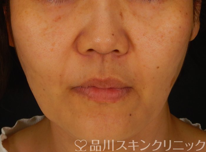 症例NO.62712のBEFORE写真