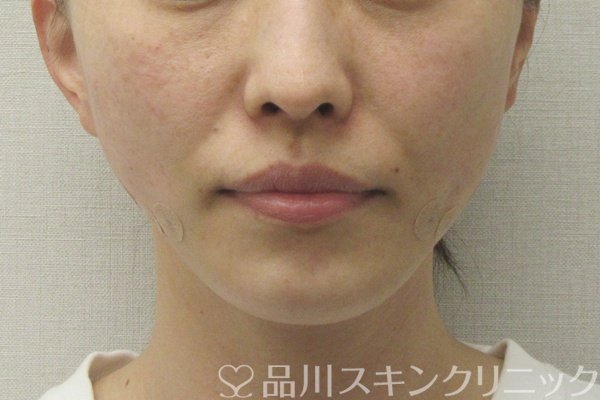 症例NO.74647のAFTER写真