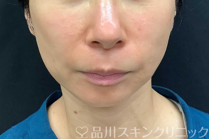 症例NO.69840のAFTER写真