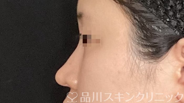 症例NO.65074のBEFORE写真