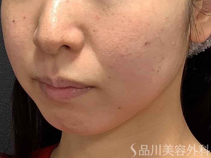 症例NO.75306のBEFORE写真