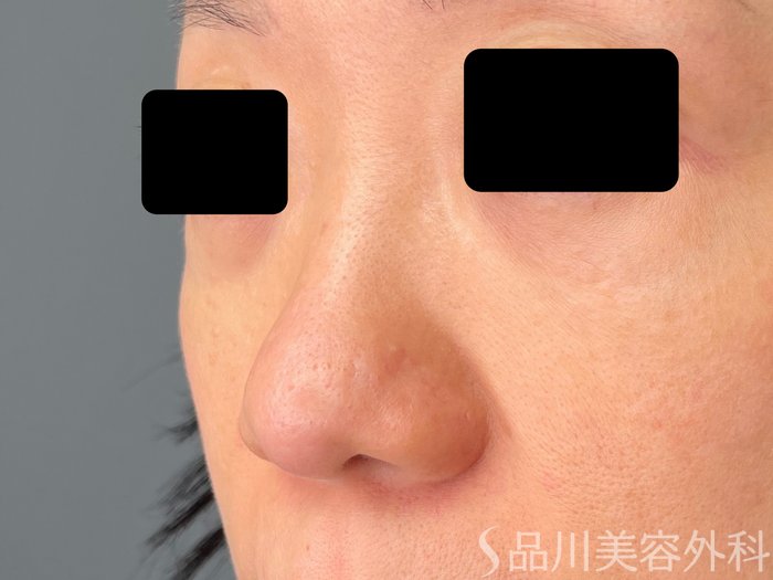 症例NO.72343のBEFORE写真