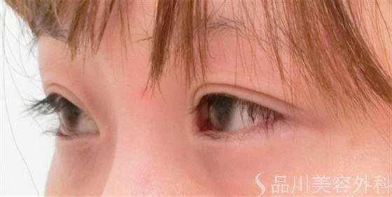 症例NO.25387のBEFORE写真