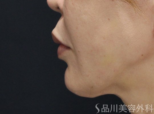 症例NO.74958のAFTER写真