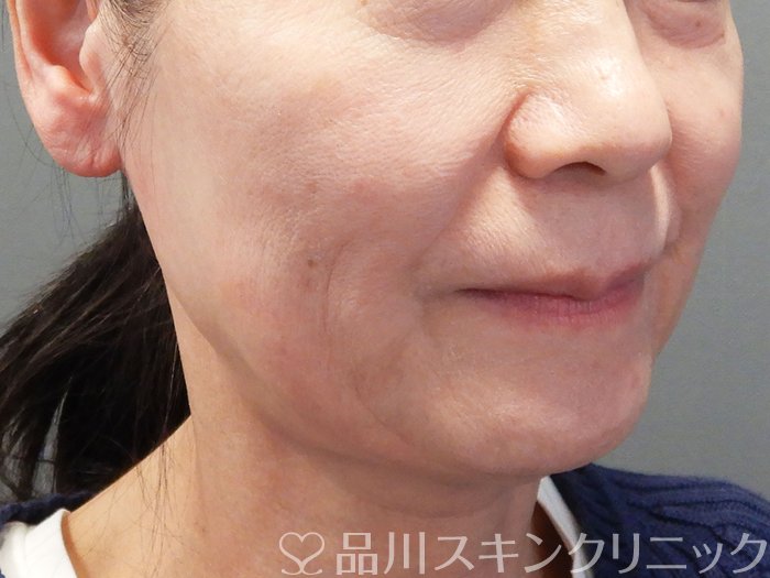 症例NO.73699のBEFORE写真