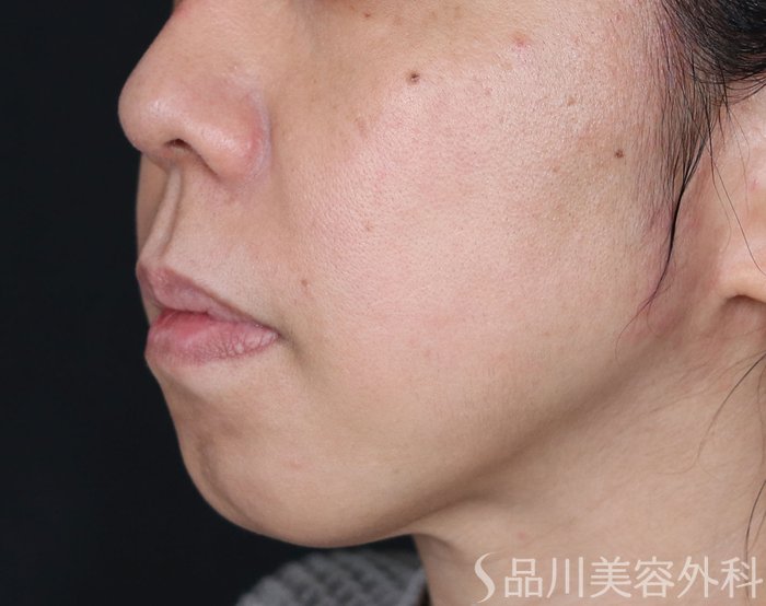 症例NO.72203のBEFORE写真