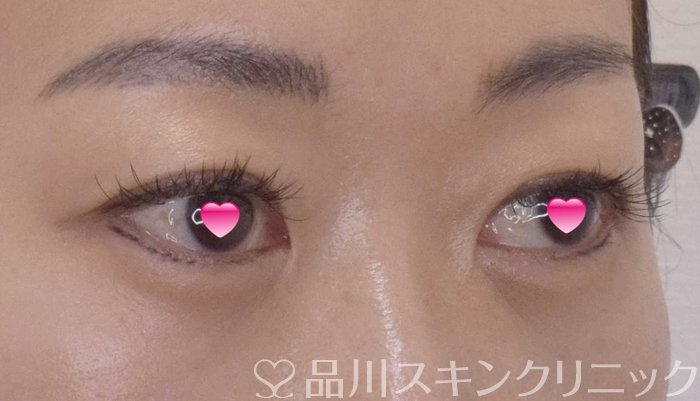 症例NO.65062のAFTER写真