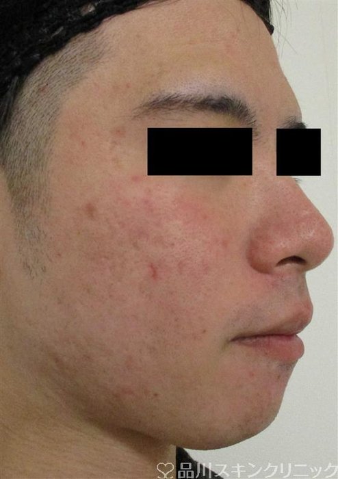 症例NO.61580のBEFORE写真