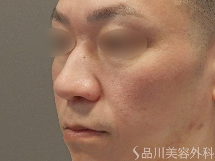症例NO.70476のBEFORE写真