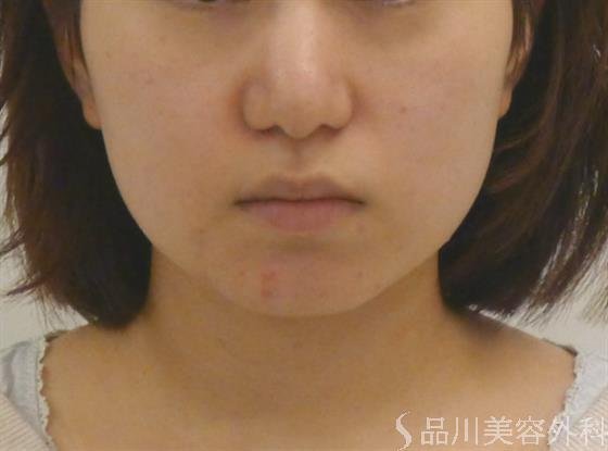 症例NO.41249のBEFORE写真