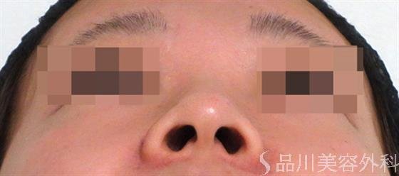 症例NO.35704のBEFORE写真