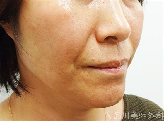 症例NO.32824のBEFORE写真