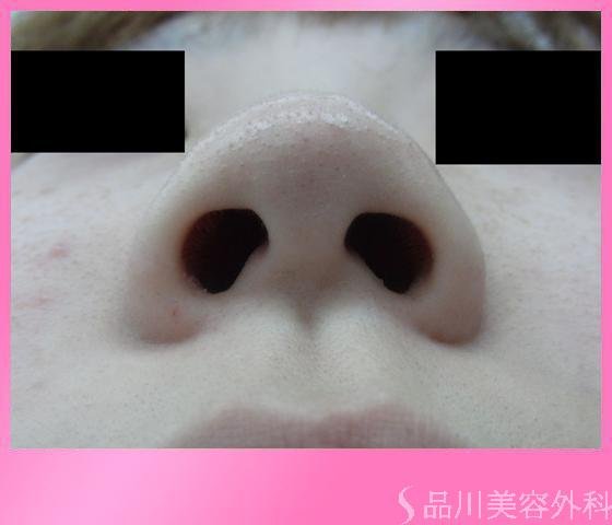 症例NO.2950のBEFORE写真