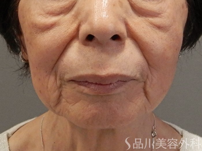 症例NO.70287のBEFORE写真