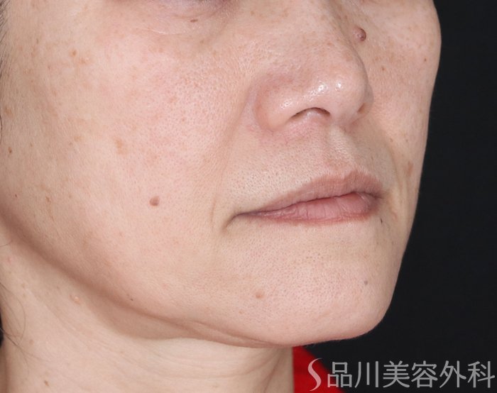 症例NO.73379のBEFORE写真