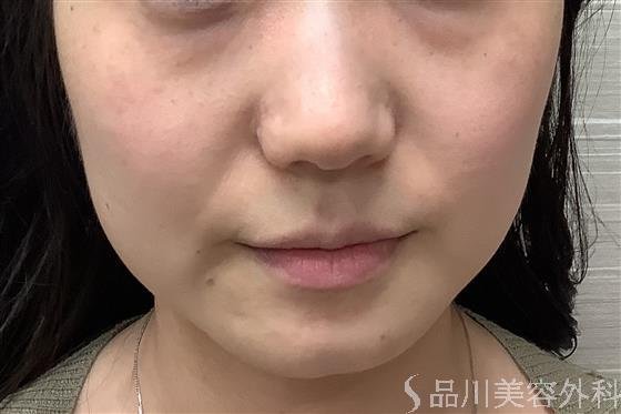 症例NO.59494のBEFORE写真