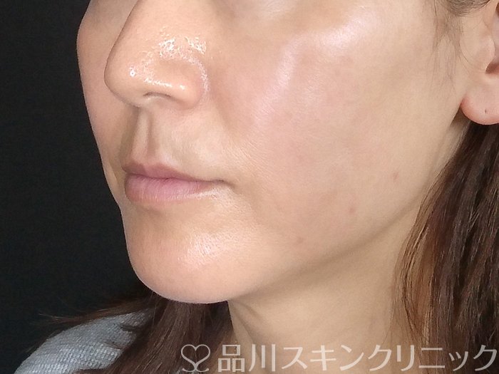 症例NO.69715のAFTER写真