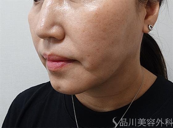 症例NO.61740のAFTER写真
