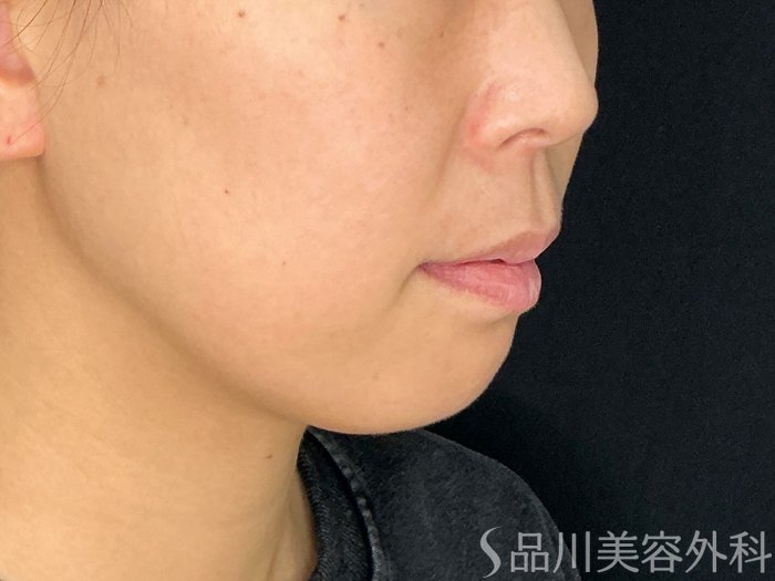 症例NO.72621のBEFORE写真